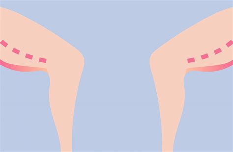 The Different Types Of Thigh Lift Procedures Compared